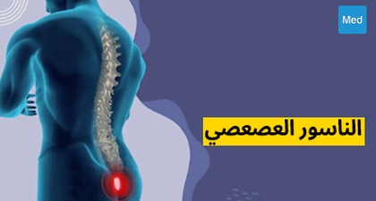 الناسور العصعصي: فهم هذا المرض المزعج