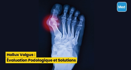Hallux Valgus : Évaluation Podologique et Solutions