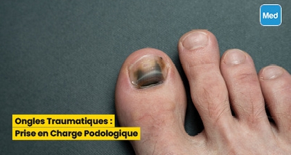 Ongles Traumatiques : Prise en Charge Podologique