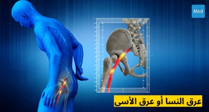 عرق النسا أو عرق الأسى