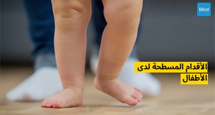 الأقدام المسطحة لدى الأطفال