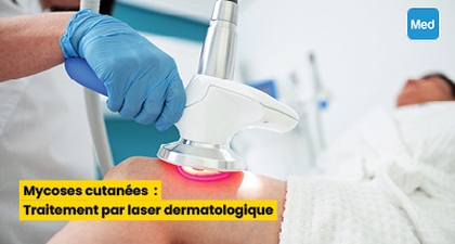 Mycoses cutanées : Traitement par laser dermatologique