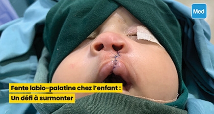Fente labio-palatine chez l'enfant : Un défi à surmonter
