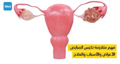 فهم متلازمة تكيس المبايض: الأعراض والأسباب والعلاج