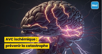AVC ischémique : prévenir la catastrophe