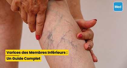 Varices des Membres Inférieurs : Un Guide Complet