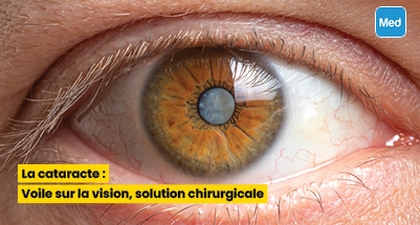 La cataracte : Voile sur la vision, solution chirurgicale