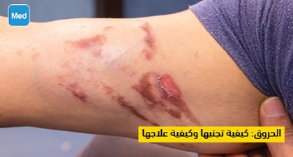 الحروق : كيفية تجنبها وكيفية علاجها 
