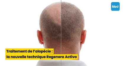 Traitement de l'alopécie : la nouvelle technique Regenera Activa