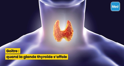 Goitre : quand la glande thyroïde s'affole