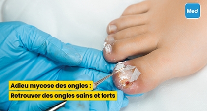 Adieu mycose des ongles : Retrouver des ongles sains et forts