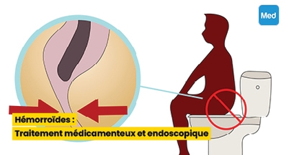 Hémorroïdes : Traitement médicamenteux et endoscopique