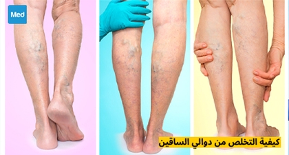 كيفية التخلص من دوالي الساقين