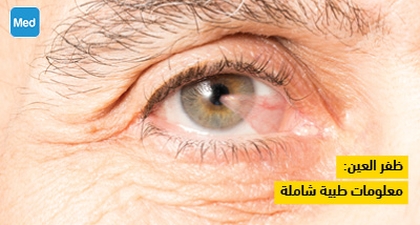 ظفر العين: معلومات طبية شاملة