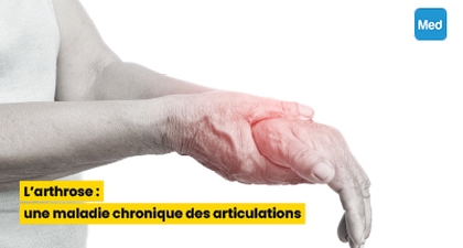 L'arthrose : une maladie chronique des articulations