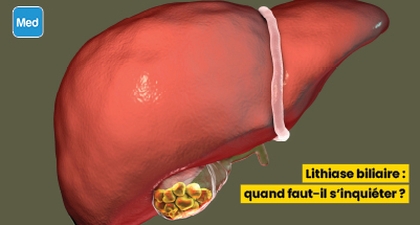 Lithiase biliaire : quand faut-il s'inquiéter ?