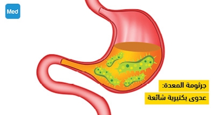 جرثومة المعدة: عدوى بكتيرية شائعة
