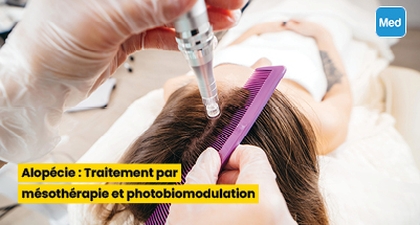 Alopécie : Traitement par mésothérapie et photobiomodulation