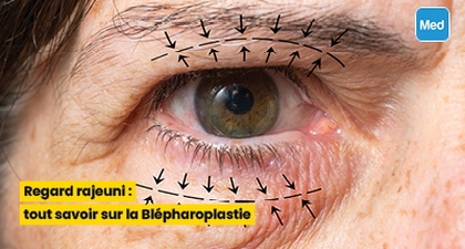 Regard rajeuni : tout savoir sur la Blépharoplastie