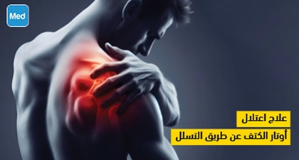 علاج اعتلال أوتار الكتف عن طريق التسلل