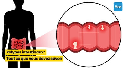 Polypes intestinaux : Tout ce que vous devez savoir