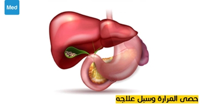 حصى المرارة وسبل علاجه
