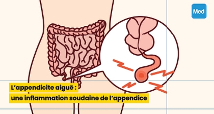 L'appendicite aiguë : une inflammation soudaine de l'appendice