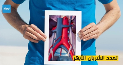 تمدد الشريان الأبهر