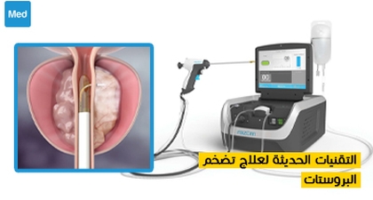 التقنيات الحديثة لعلاج تضخم البروستات