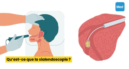 Qu’est-ce que la sialendoscopie ?