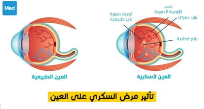 تأثير مرض السكري على العين