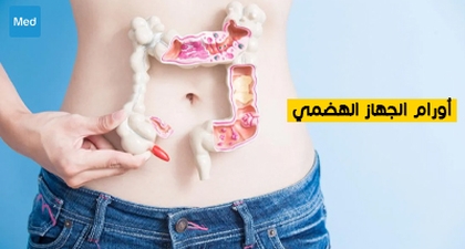 أورام الجهاز الهضمي 