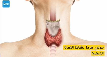 مرض فرط نشاط الغدة الدرقية