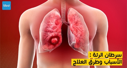 سرطان الرئة : الأسباب وطرق العلاج