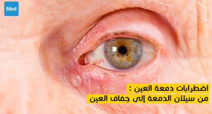 اضطرابات دمعة العين : من سيلان الدمعة إلى جفاف العين