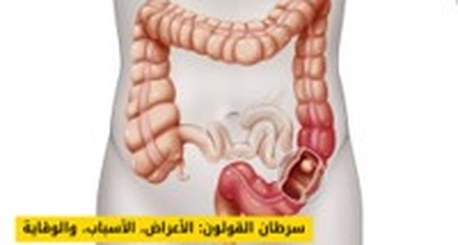 سرطان القولون: الأعراض، الأسباب، وكيفية الوقاية والتشخيص المبكر