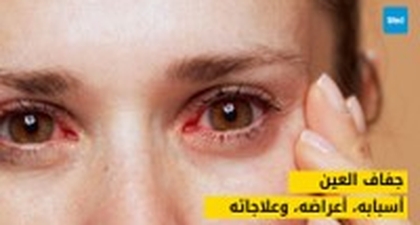 جفاف العين: أسبابه، أعراضه، وعلاجاته