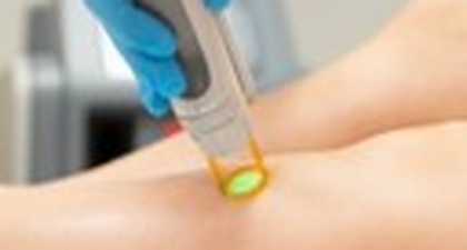 L’Épilation Laser – Une Solution Durable pour une Peau Lisse