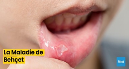 La maladie de Behçet : une pathologie multisystémique