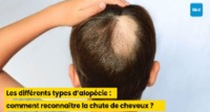 Les différents types d’alopécie : comment reconnaître la chute de cheveux ?