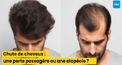 Chute de cheveux : comment distinguer une perte passagère d’une alopécie ?