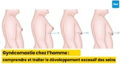 Gynécomastie chez l’homme : comprendre et traiter le développement excessif des seins
