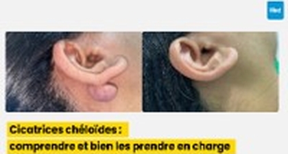Cicatrices chéloïdes : comprendre et bien les prendre en charge