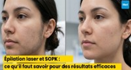 Épilation laser et SOPK : ce qu’il faut savoir pour des résultats efficaces