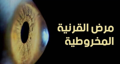 مرض القرنية المخروطية