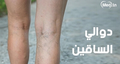 دوالي الساقين