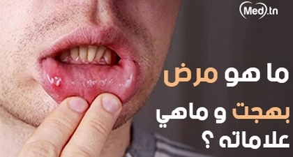 ماهو مرض بهجت و ماهي علاماته ؟